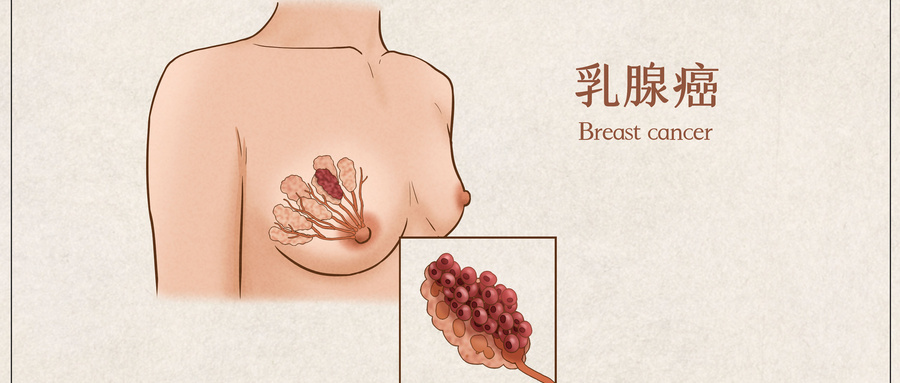 乳腺癌做b超能查出吗 女性乳腺检查项目