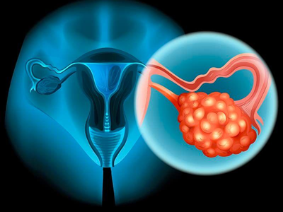 女性卵巢癌去医院做什么检查？